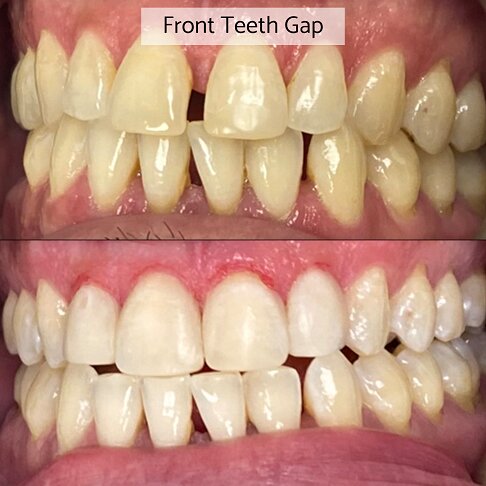 Composite Bonding London - Front Tooth Gap