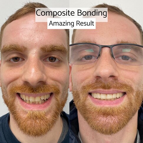 Composite Bonding Result - London Waterloo & Marble Arch