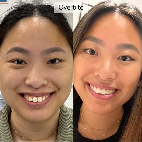 Invisalign Cost London - woman with overbite