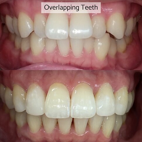 Invisalign Free Consultation in London - overlapping teeth