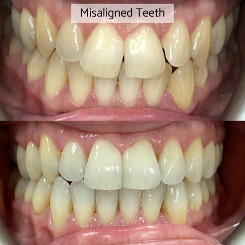 Invisalign London - misaligned teeth