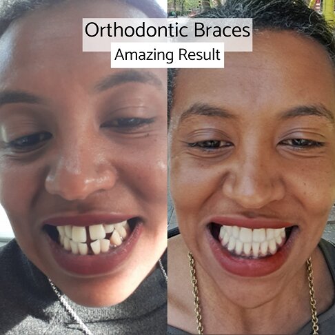 Metal Braces - Before and after result