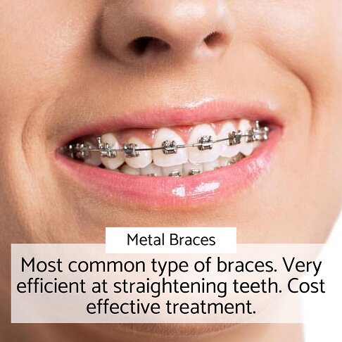 photo of woman smiling in metal braces, toward the final phase of treatment