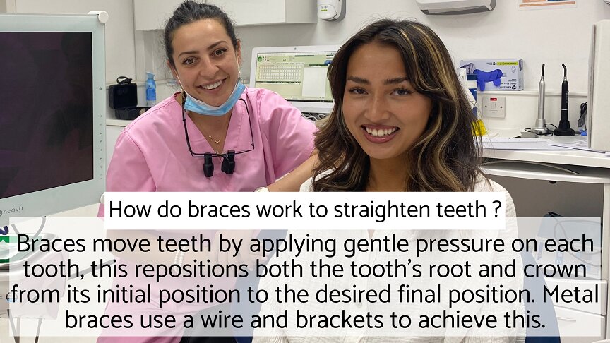 Metal Braces - How do metal braces work to move teeth
