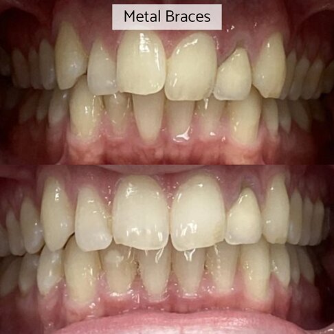 Metal Braces - Teeth Overlap Correction