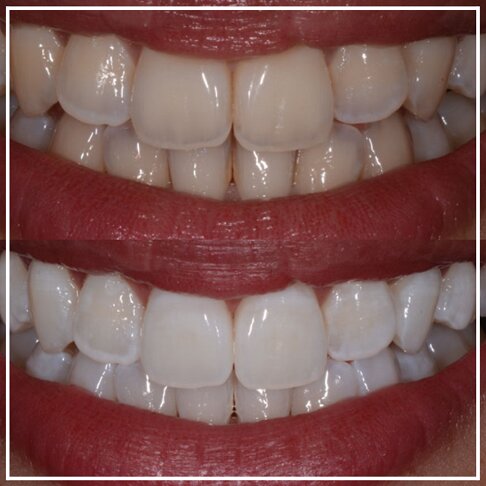 photo of before and after - patient Enlighten Teeth Whitening treatment