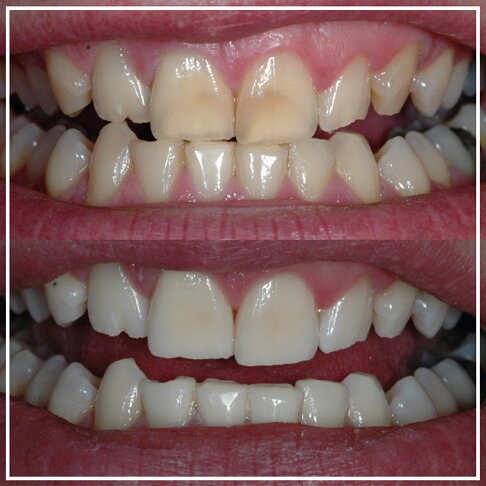 Patient results - Enlighten Teeth Whitening Before And After