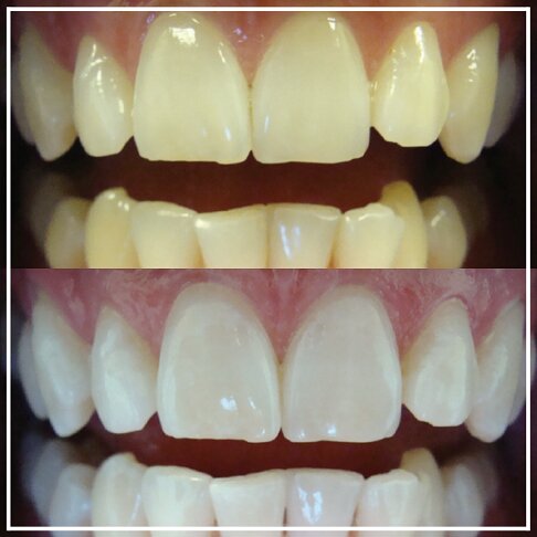 patient - Enlighten Teeth Whitening Before And After