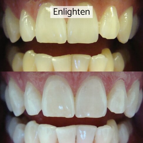 Enlighten whitening London - before and after 1