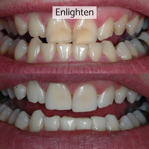 Enlighten whitening London - before and after 2