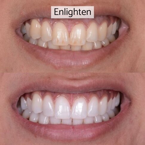 Enlighten whitening London - before and after 3