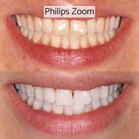 Home Teeth Whitening London - Philips Zoom Before And After 1