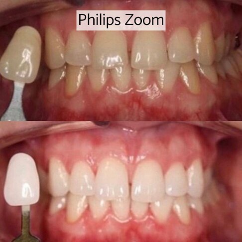 In-clinic Zoom laser light teeth whitening London - before and after 1