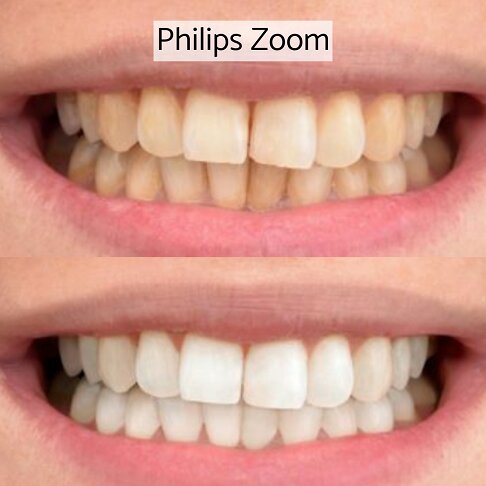 In-clinic Zoom laser light teeth whitening London - before and after 2