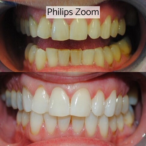 In-clinic Zoom laser light teeth whitening London - before and after 3