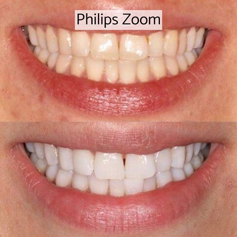 In-clinic Zoom laser light teeth whitening London - before and after 4