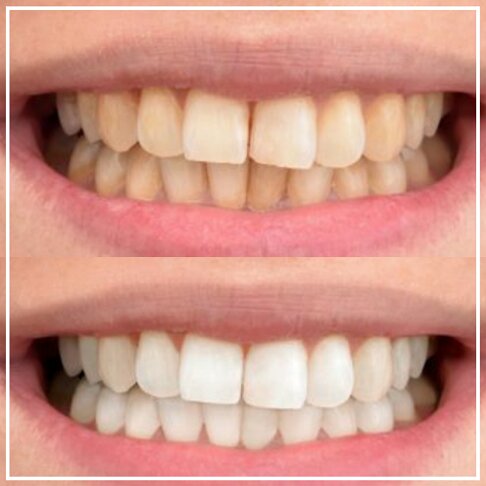 Philips Zoom Home Teeth Whitening patient photo - Before And After