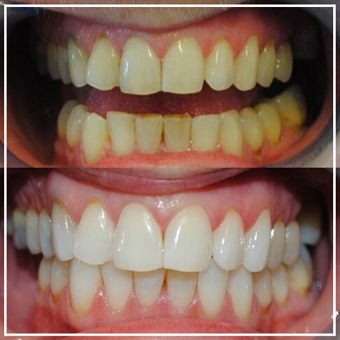 Philips Zoom Home Teeth Whitening. Teeth and gums - Before And After