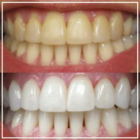 Philips Zoom Instant Laser In Surgery Teeth Whitening Before And After 2