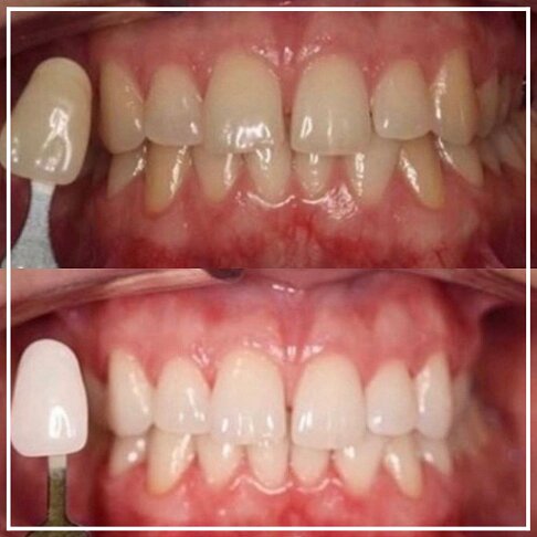 Philips Zoom Instant Laser Teeth Whitening Before And After