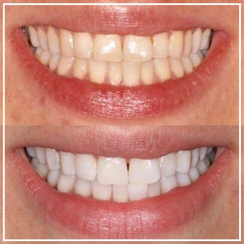 photo of patients mouth - Zoom Teeth Whitening Before And After