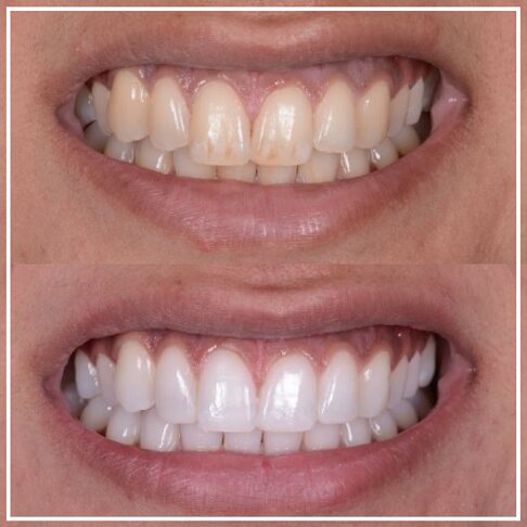 In-clinic photo showing before and after teeth whitening