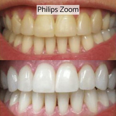 Philips Zoom Teeth Whitening London - Zoom home whitening before and after 2
