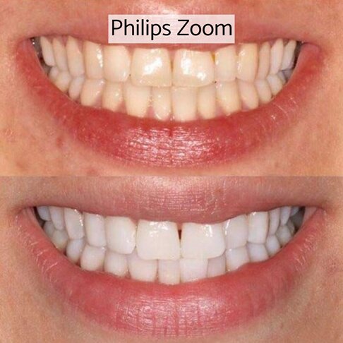 Philips Zoom Teeth Whitening London - Zoom home whitening before and after