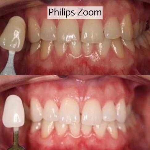 Philips Zoom Teeth Whitening London - Zoom instant laser in-clinic whitening before and after
