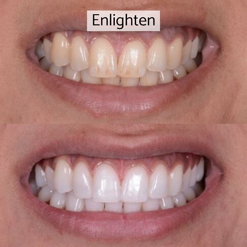 Teeth Whitening Cost London - Enlighten Before And After 2