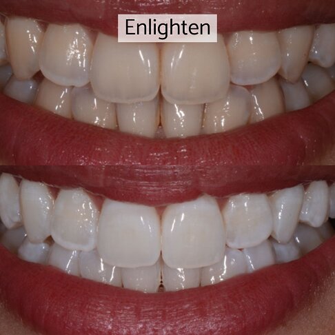 Teeth Whitening London - Enlighten Before And After 1