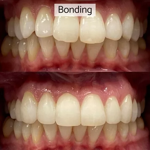 Dental Veneers Vs Composite Bonding - Bonding Before After Photo