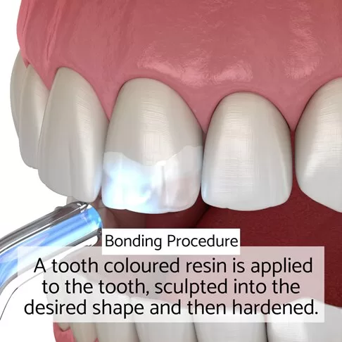 Dental Veneers Vs Composite Bonding - Bonding Procedure