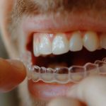 Discover the Benefits of Invisalign: A Comprehensive Guide to Teeth Straightening