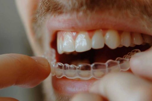 Discover the Benefits of Invisalign: A Comprehensive Guide to Teeth Straightening