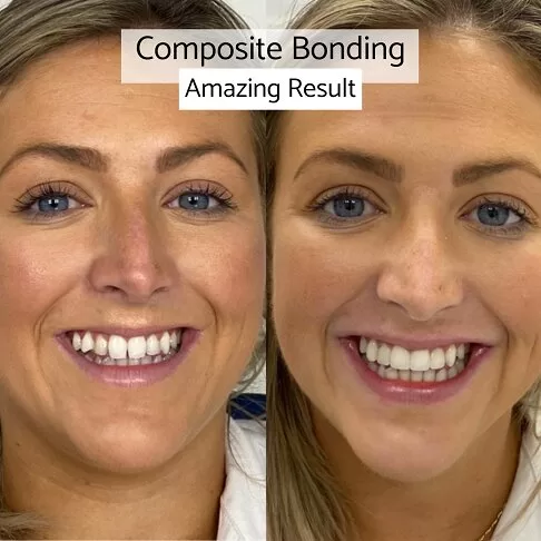 Composite Bonding Dentist In London Waterloo And Marble Arch