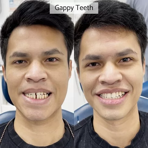 Cost Of Correcting A Gappy Smile Corrected With Veneers In London - See Our Before After Results