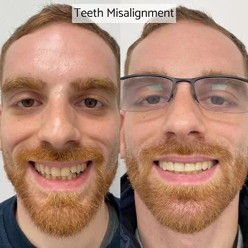 Dental Veneers Before And After - Crooked Misaligned Teeth Corrected With Porcelain Veneers