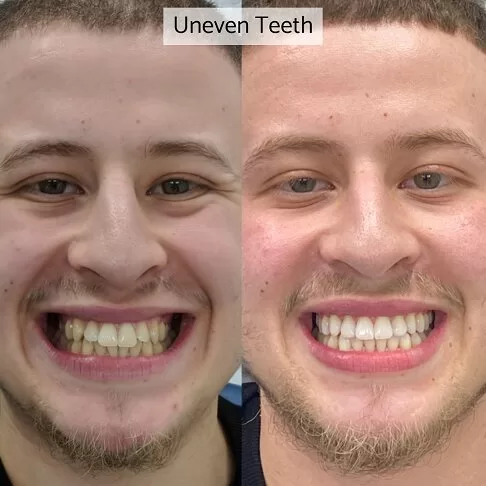 Dental Veneers Before And After - Uneven Teeth Corrected With Porcelain Veneers