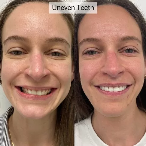 Dental Veneers Before And After - Unevenly Sized Teeth