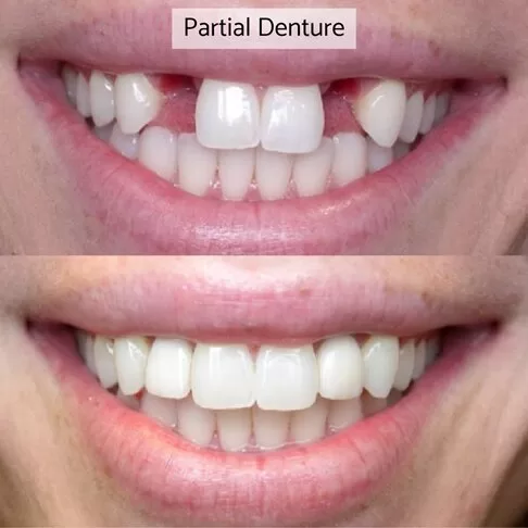 Dentures London - before and after