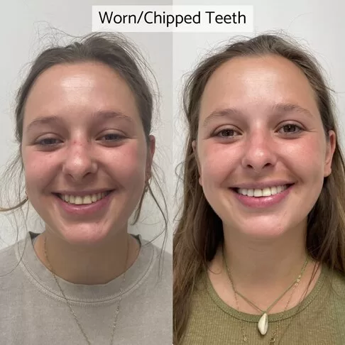 Porcelain Veneers In London - Before After - Worn Out Chipped Teeth