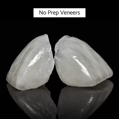 Porcelain Veneers In London - No Prep Veneers Lumineers