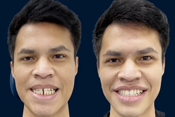 Porcelain Veneers In London - before after picture of a man with gappy teeth