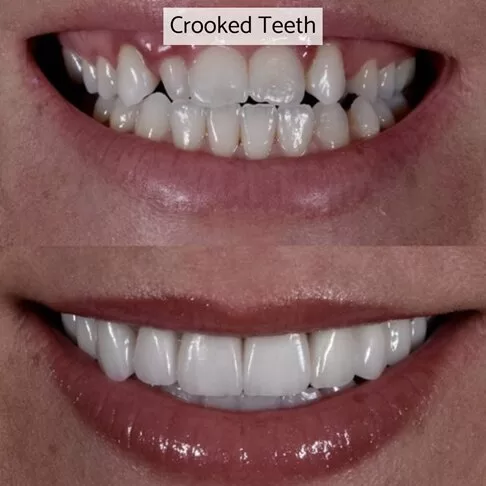 Porcelain Veneers In London - fixing crooked teeth