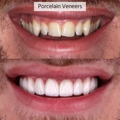 Porcelain Veneers Vs Composite Veneers - Porcelain Veneers Before After Photo