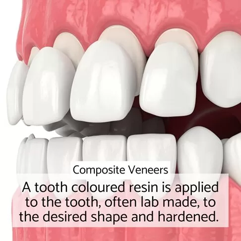 Porcelain Veneers Vs Composite Veneers - What Are Composite Veneers