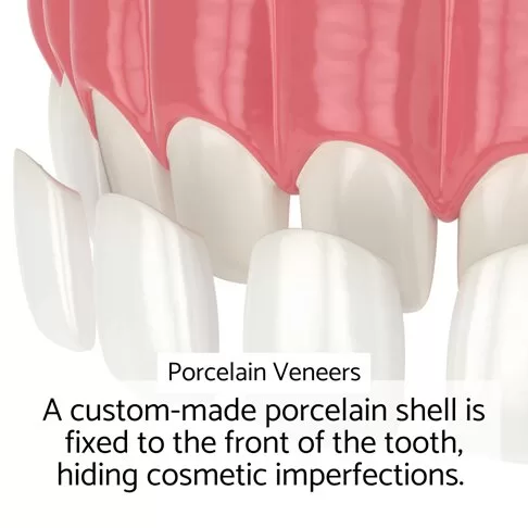 Porcelain Veneers Vs Composite Veneers - What Are Porcelain Veneers