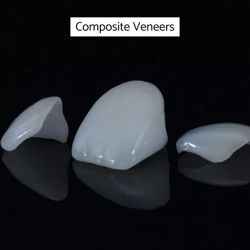 Veneers Cost London - Composite Veneers Cost