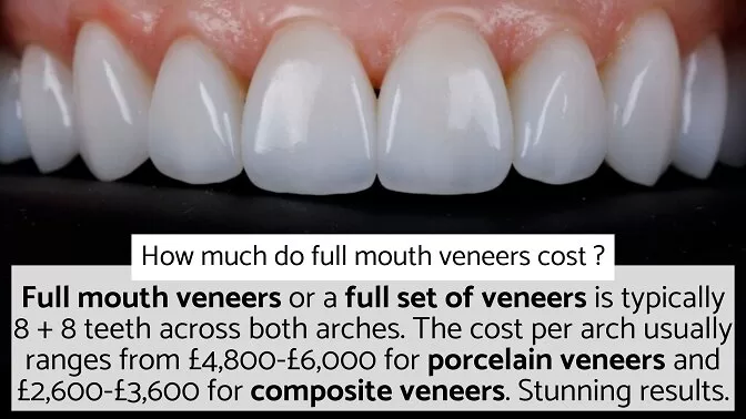 Veneers Cost London - How Much Do Full Mouth Veneers Cost